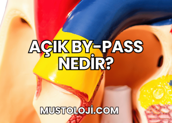 Açık By-Pass Nedir?
