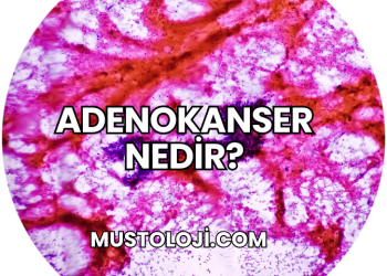 Adenokanser Nedir?