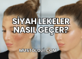 Siyah Lekeler Nasıl Geçer?