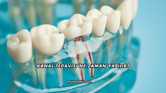 Kanal Tedavisi Ne Zaman Yapılır?